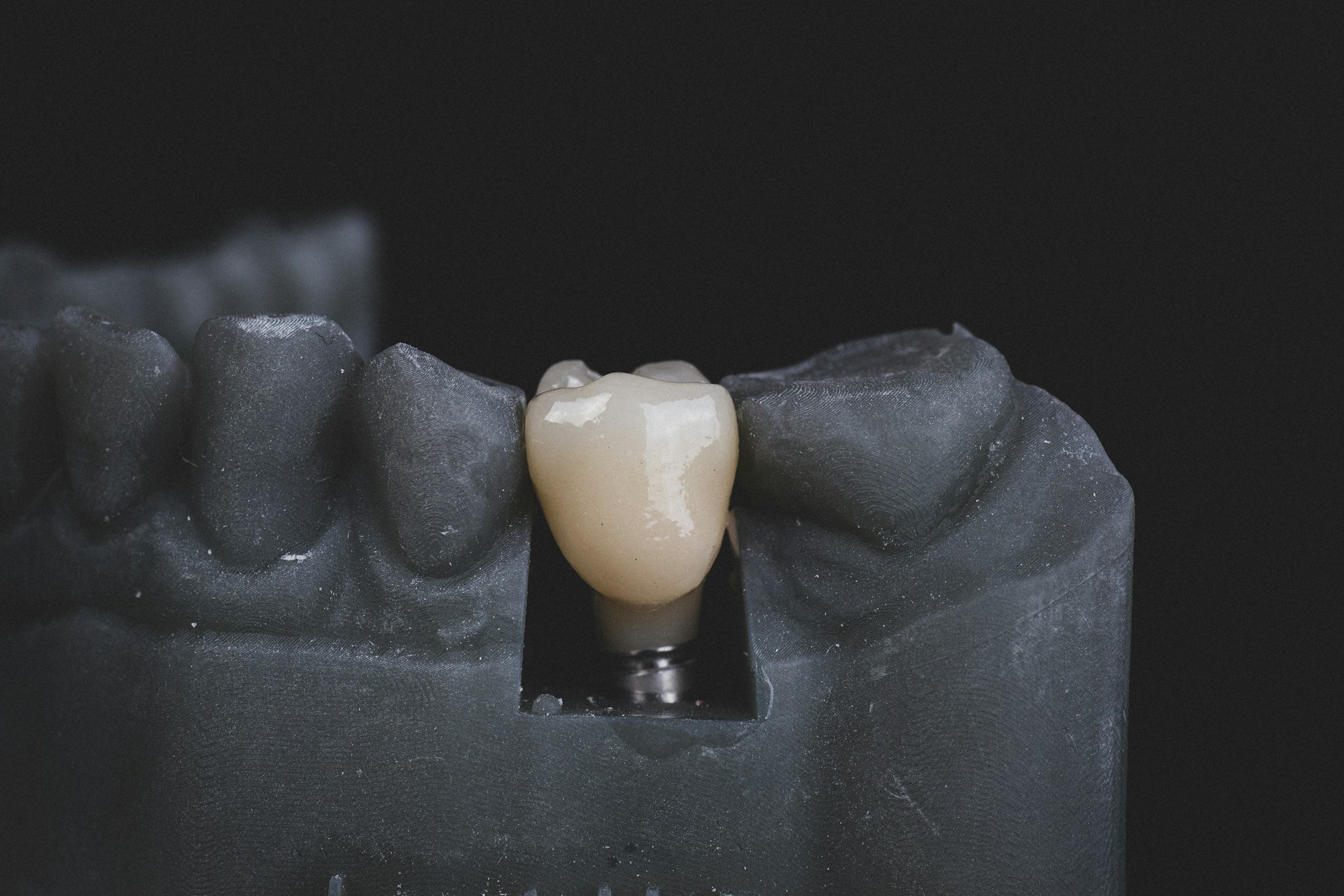 Implants dentaires : investissement et facteurs influençant le prix